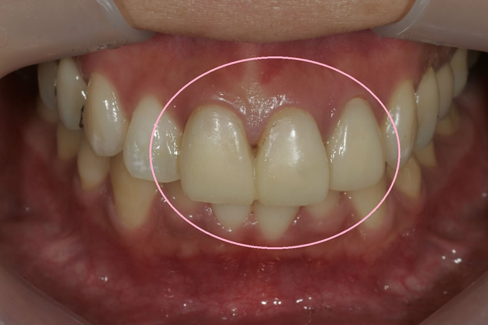 仮歯の精度の重視